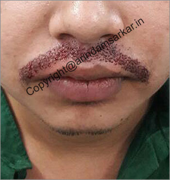 Moustache transplant picture - post surgery