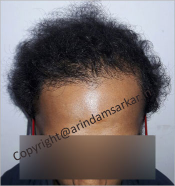 Hair Transplant surgery picture -  post surgery