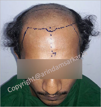 Hair Transplant surgery picture -  pre surgery