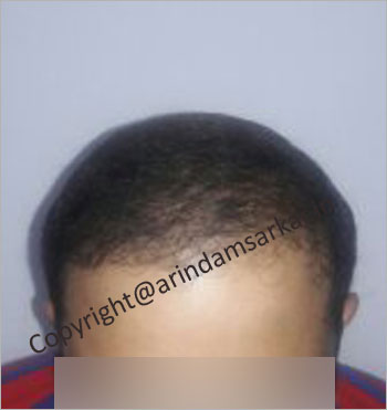 male Hair Transplant picture -  post surgery