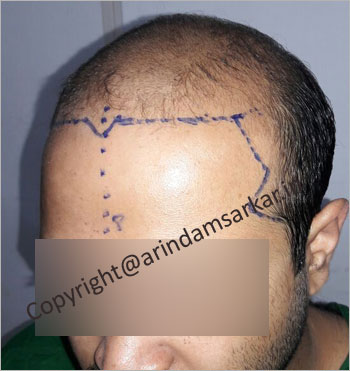 male Hair Transplant picture -  pre surgery
