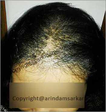 female Hair Transplant picture -  pre surgery