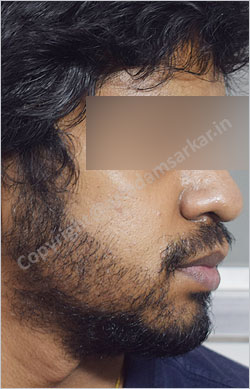 Beard Transplant picture -  post surgery