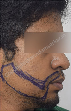Beard Transplant picture -  pre surgery