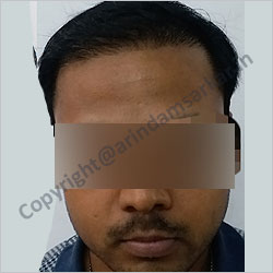 Hair Transplant picture -  post surgery