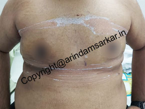 Gynecomastia surgery in Kolkata