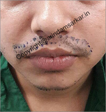 Moustache hair Transplant picture -  pre surgery