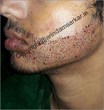 Hair Transplant in Kolkata - Know Cost for Beard and Mustache Transplant