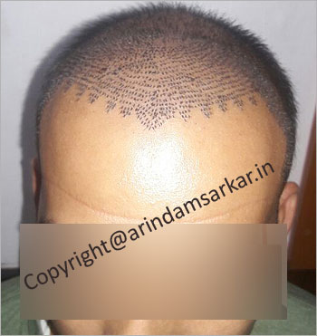 fue Hair Transplant picture-  post surgery