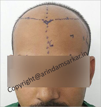 fue Hair Transplant picture -  pre surgery