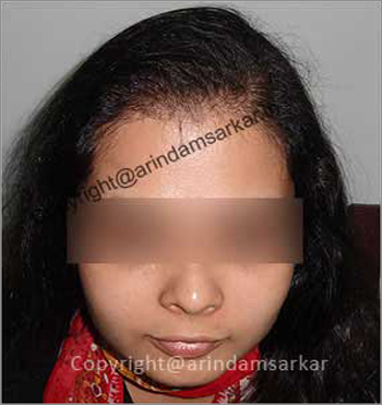 female Hair Transplant picture -  post surgery