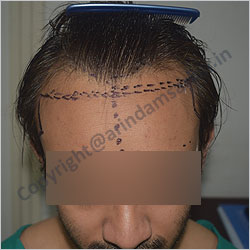 Hair Transplant picture -  pre surgery