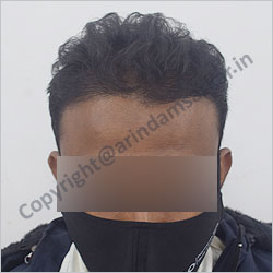 Hair Transplant picture -  post surgery