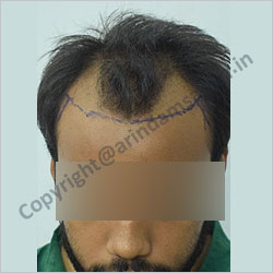Hair Transplant picture -  pre surgery